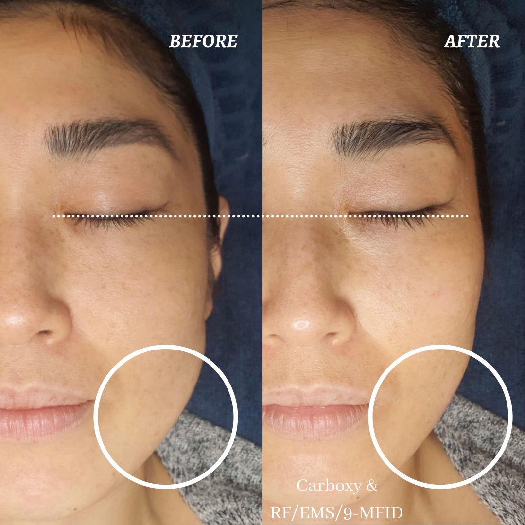 eye luxe_eyelash extention singapore_facial 2